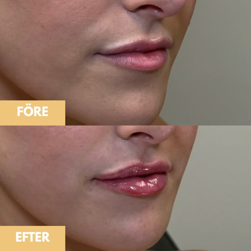 Lips Plumper